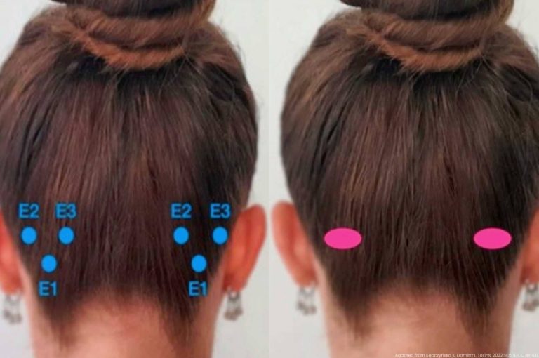 Posterior view of occipital botulinum toxin injection sites for chronic migraine, showing PREEMPT protocol landmarks and alternative technique zones. Image adapted from: Kępczyńska K, Domitrz I. Botulinum Toxin—A Current Place in the Treatment of Chronic Migraine and Other Primary Headaches. Toxins. 2022;14(9):619. DOI: 10.3390/toxins14090619