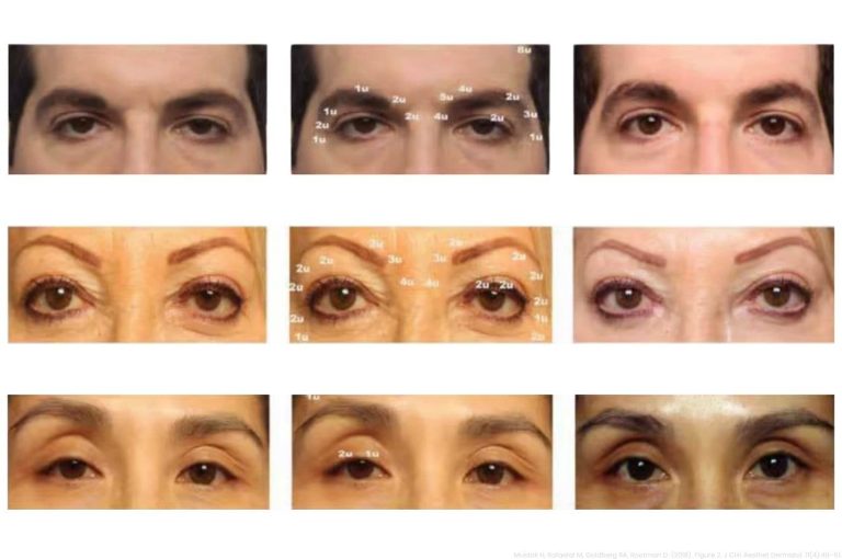 Pre- and post-injection photographs showing botulinum toxin correction of mild eyelid ptosis with injection pattern markings