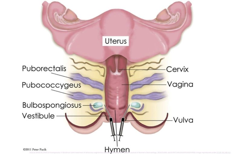 Anatomical diagram showing BoNTA injection sites in the bulbospongiosus, pubococcygeus, and puborectalis muscles for treating vaginismus.