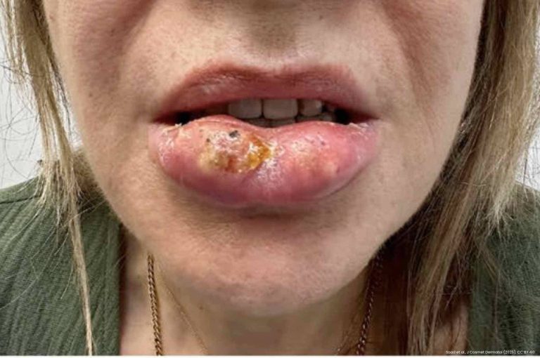 Close-up of a female patient with severe swelling, crusting, and abscess formation on the lower lip following hyaluronic acid filler injection, prior to treatment.
