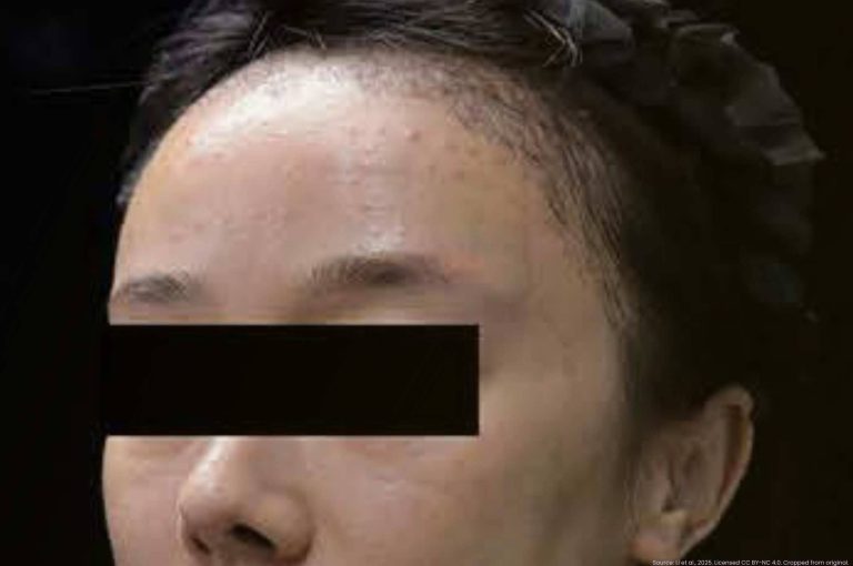 Pre-treatment clinical photograph showing multiple dark-red papules and nodules on the upper face of a woman with delayed-onset nodules following dermal filler injection; image from Li et al., 2025 case report on abrocitinib therapy.