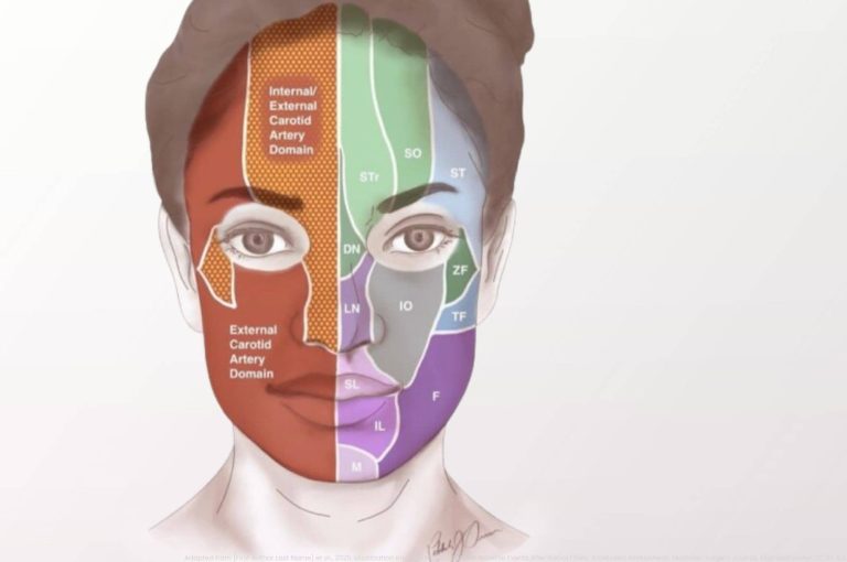 Anatomical illustration of facial vascular territories showing arterial branches and zones used to localize and stage vascular complications after dermal filler injections.