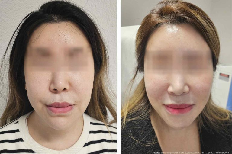 Before and after photos of a female patient with hyaluronic acid-induced fibrotic bulges along the nasolabial fold, treated with intralesional triamcinolone. Image from: Peros I, Haneke E. “Fibrotic Reaction to Hyaluronic Acid Fillers in the Face,” J Cosmet Dermatol, 2024.