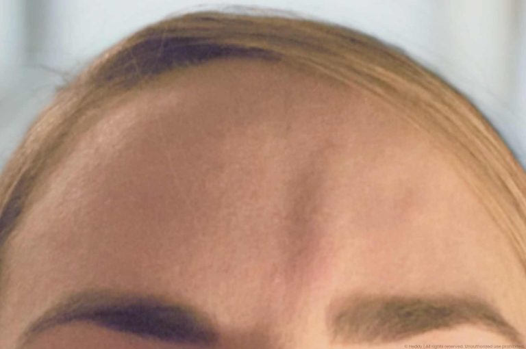Forehead foreign body granuloma following polymethylmethacrylate (PMMA) filler injection, prior to successful treatment with allopurinol.
