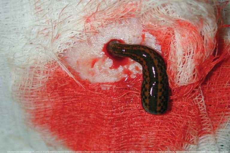 Clinical photo of a medical leech (Hirudo medicinalis) applied to a nasal tip to treat venous congestion and vascular compromise following dermal filler injection.
