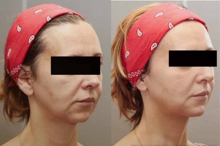 Before-and-after image of a female patient treated for lower face aging, showing significant improvement in jawline, marionette lines, and chin contour following injection-based rejuvenation tailored to facial morphotype.