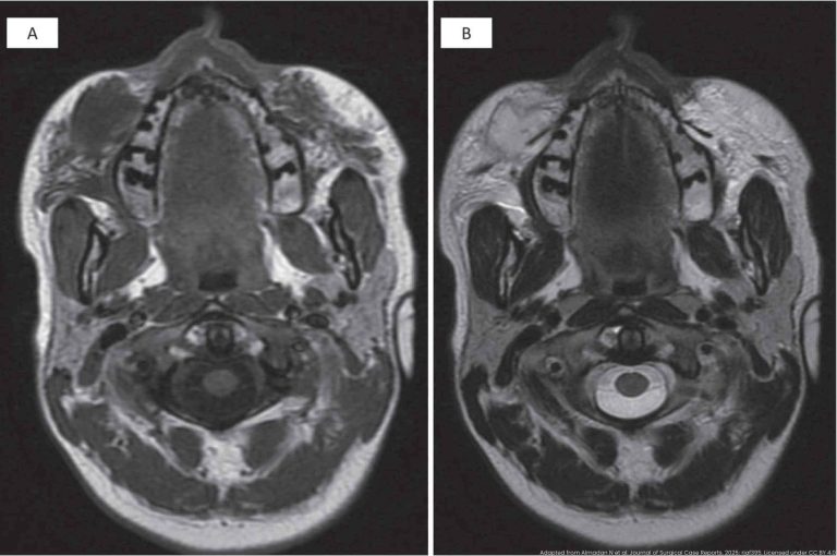 MRI showing bilateral hyaluronic acid filler deposits in cheek subcutaneous tissue with right-sided granulomatous collection and fat stranding