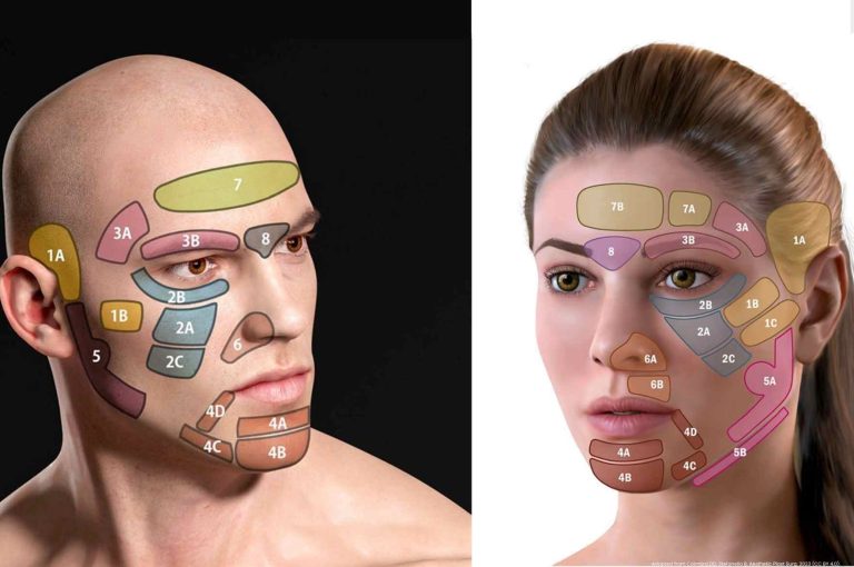 Facial injection mapping chart for male and female patients showing 3DD Lift treatment zones used in full-face rejuvenation with hyaluronic acid fillers and myomodulation techniques.
