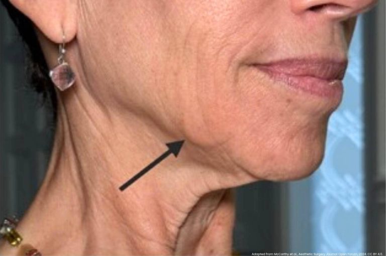 Close-up of a lower face showing a visible calcium hydroxylapatite (CaHA) nodule in the jowl area, indicated by a black arrow.