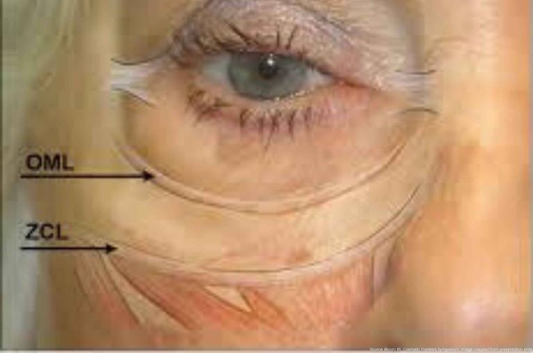Anatomical illustration of the orbital and zygomatic cutaneous ligaments (OML, ZCL) relevant to festoon and malar mound formation.