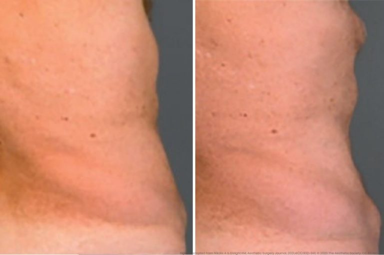 Before and after photographs showing paradoxical adipose hyperplasia following cryolipolysis treatment on female flanks