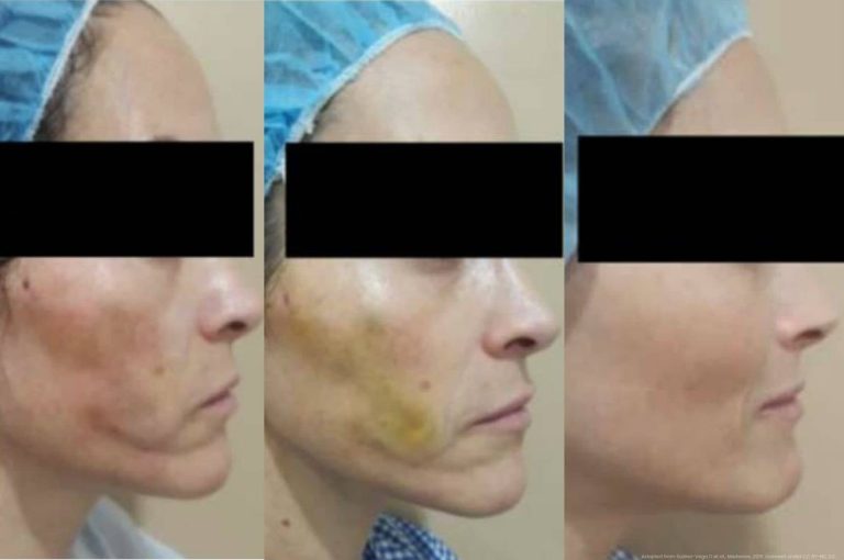 Clinical before-and-after images showing resolution of facial irregularities following hyaluronic acid–induced degradation of PDO threads, including improvement in contour and skin texture over time