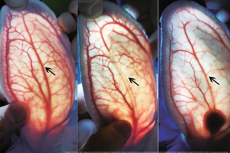 Transillumination images of rabbit ears comparing vascular occlusion after intra-arterial injection of PMMA vs. hyaluronic acid (HA), demonstrating significantly greater embolism risk and tissue necrosis with HA.