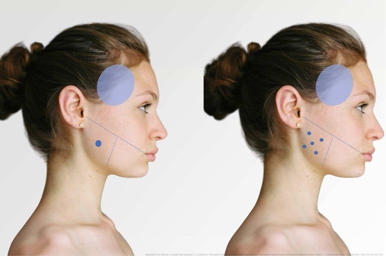 Side profile diagrams showing the single- and multi-injection patterns for masseteric neuromodulator treatment and corresponding increase in temporal volume (Nikolis et al., 2020).
