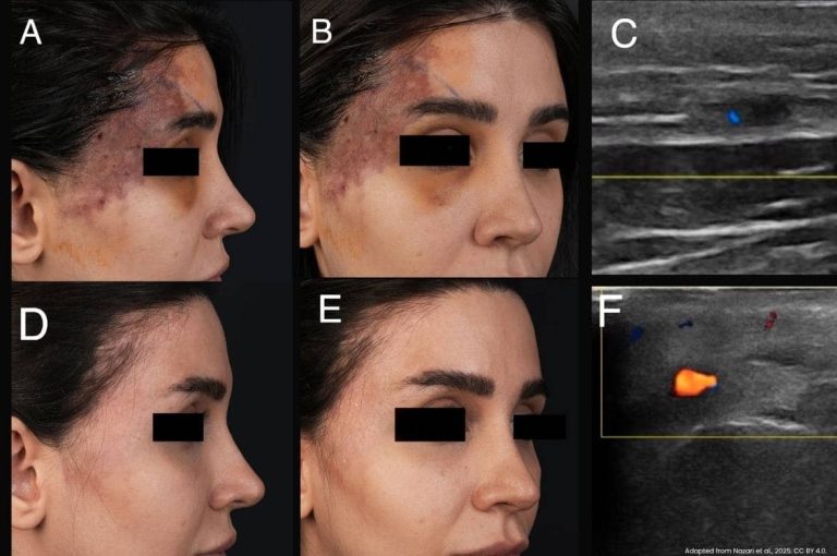 Six-panel clinical case series showing a female patient with severe filler-induced vascular occlusion presenting with facial necrosis and bruising in panels A and B, Doppler ultrasound imaging of compromised vasculature in panels C and F, and full skin recovery in panels D and E following the THIS and FAT treatment protocol, adapted from Nazari et al., Frontiers in Medicine, 2025, CC BY 4.0