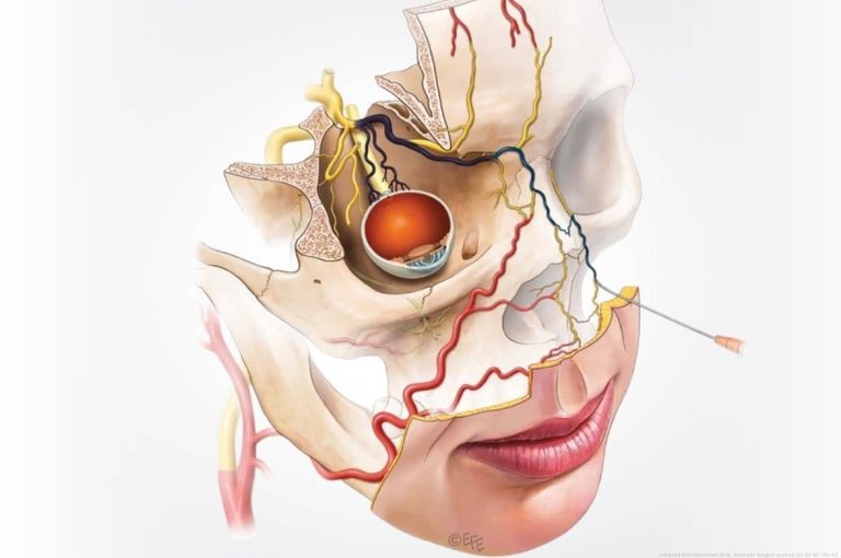 Detailed medical illustration of a cross-sectional facial anatomy showing the orbital socket, eye, cranial nerves, facial vasculature, and an injection needle approaching from the lateral midface, illustrating the vascular complexity that makes pre-injection aspiration unreliable as a safety measure, adapted from Doraivelu et al., Aesthetic Surgery Journal, CC BY-NC-ND 4.0