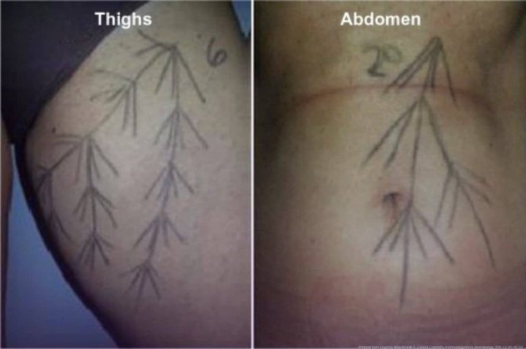 Split clinical photograph showing branching injection vector markings drawn on the thighs and abdomen demonstrating the body vectoring technique for Radiesse skin tightening, adapted from Cogorno Wasylkowski V, Clinical Cosmetic and Investigational Dermatology, 2015