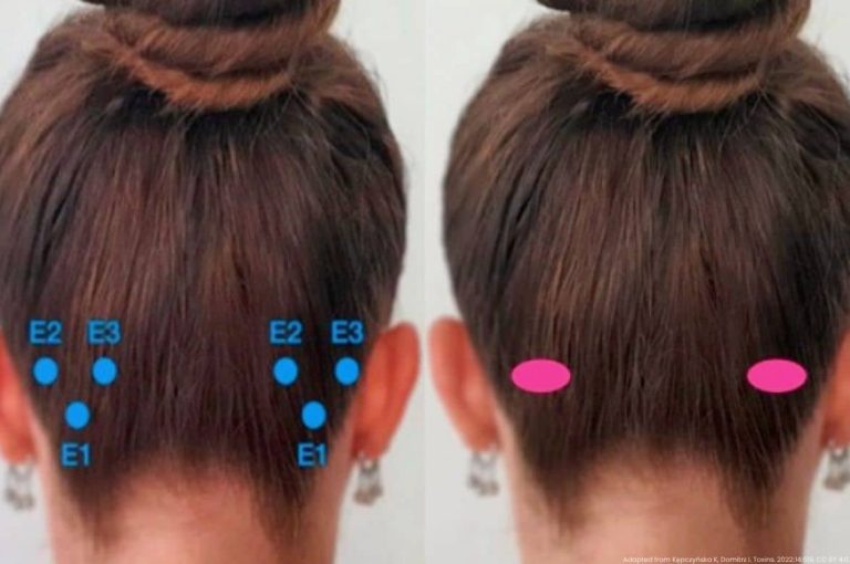 Split posterior clinical photograph showing bilateral occipital botulinum toxin injection point mapping with labeled blue dots at positions E1, E2, and E3 for chronic migraine treatment protocol, alongside comparison view, adapted from Kępczyńska K, Domitrz I, Toxins, 2022;14(3), CC BY 4.0