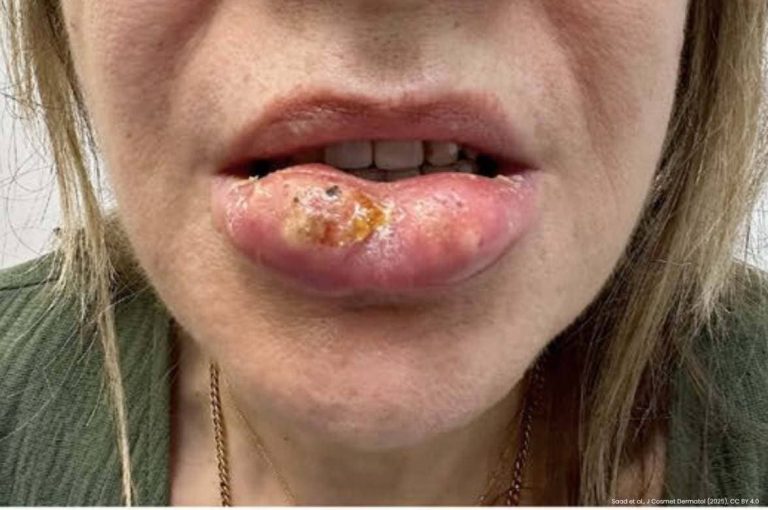 Clinical photograph of a female patient presenting with severe delayed inflammatory reaction and tissue necrosis of the lower lip following hyaluronic acid filler injection, from Saad et al., Journal of Cosmetic Dermatology, 2025, CC BY 4.0
