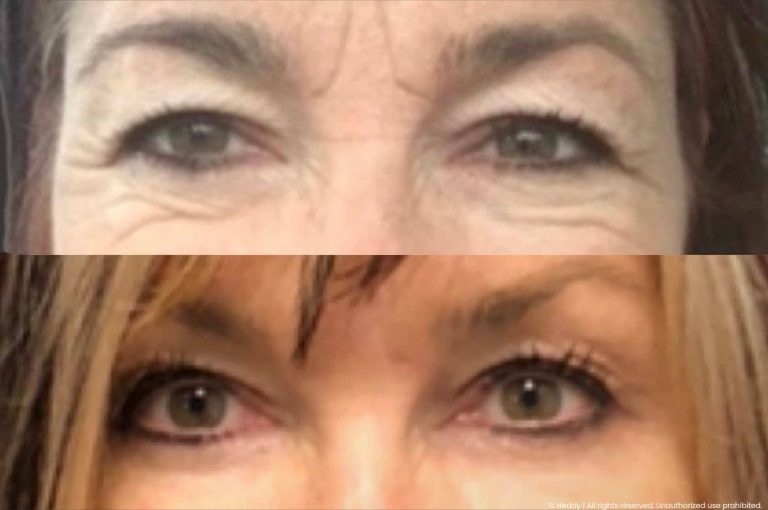 Before and after clinical photographs showing periorbital and glabellar region of two female patients demonstrating reduction in dynamic wrinkles and improved skin texture following combination hyaluronic acid filler and neuromodulator treatment, illustrating multimodality approach to patient retention in aesthetic medicine