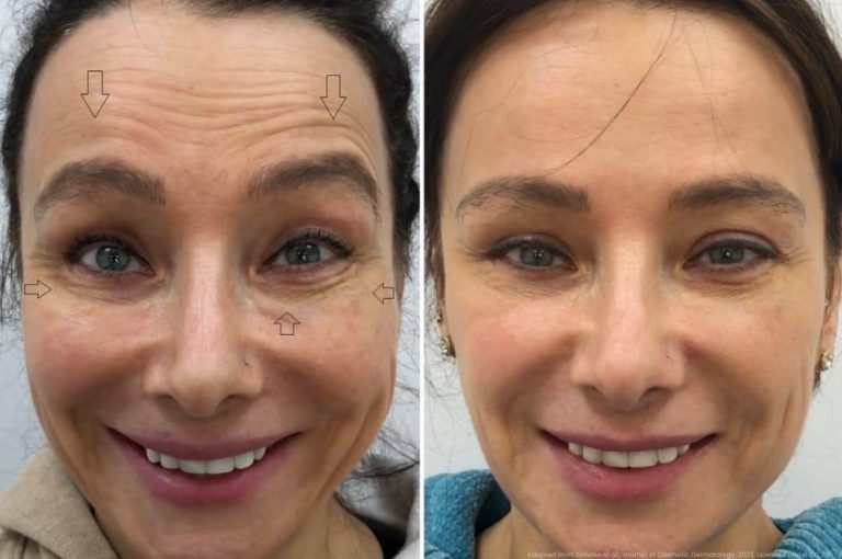 Before and after clinical photographs of a female patient showing facial overfilling with annotated arrows indicating areas of volume excess and restricted facial movement, alongside post-dissolution result demonstrating restored natural expression, adapted from Scheike et al., Journal of Cosmetic Dermatology, 2023, CC BY
