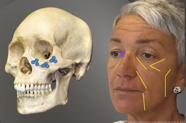 Clinical composite image showing a human skull with blue injection point markers alongside a female patient with yellow line overlays indicating dual plane filler injection vectors for midface and cheek rejuvenation, adapted from Salti and Rauso, Journal of Cutaneous and Aesthetic Surgery, 2015