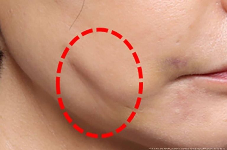 Clinical photograph showing skin dimpling complication on the cheek following facial thread lift procedure with red dashed circle highlighting the affected area, from Yi K-H and Park SY, Journal of Cosmetic Dermatology, 2025;24:e16745