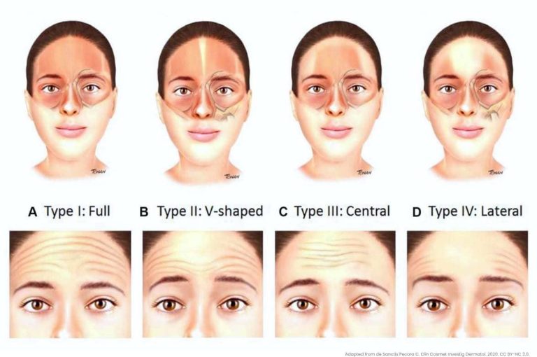 Eight-panel clinical illustration showing four forehead muscle activation patterns — Type I Full, Type II V-shaped, Type III Central, and Type IV Lateral — paired with corresponding patient photographs demonstrating forehead wrinkle distribution to guide customizable incobotulinumtoxinA injection protocol, adapted from de Sanctis Pecora C, Clinical Cosmetic and Investigational Dermatology, 2020, CC BY-NC 3.0