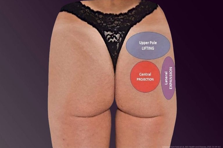 Gluteal injection mapping diagram showing upper pole lifting, central projection, and lateral expansion zones for hyaluronic acid and poly-L-lactic acid treatment