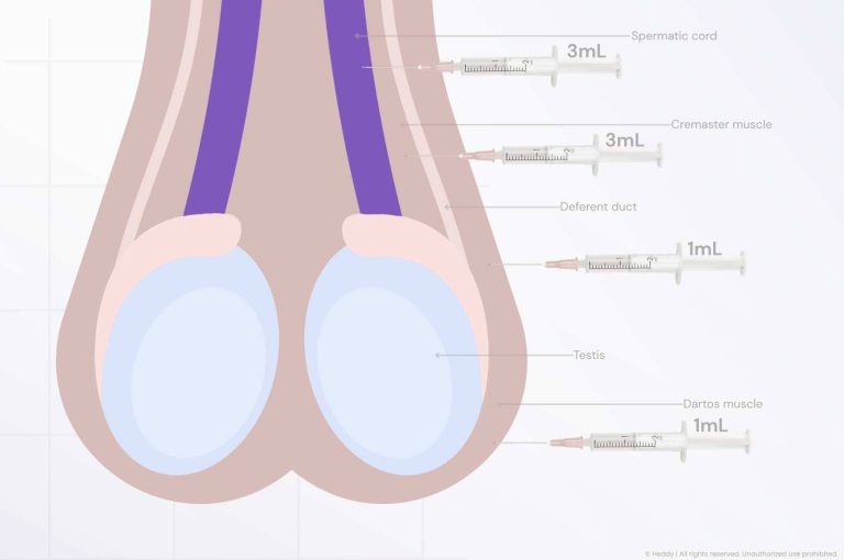 Original Heddy clinical illustration showing a cross-sectional diagram of scrotal anatomy with labeled structures including spermatic cord, cremaster muscle, deferent duct, testis, and dartos muscle, with four syringes indicating intrascrotal botulinum toxin A injection points and volumes of 3mL, 3mL, 1mL, and 1mL for male genital aesthetic treatment