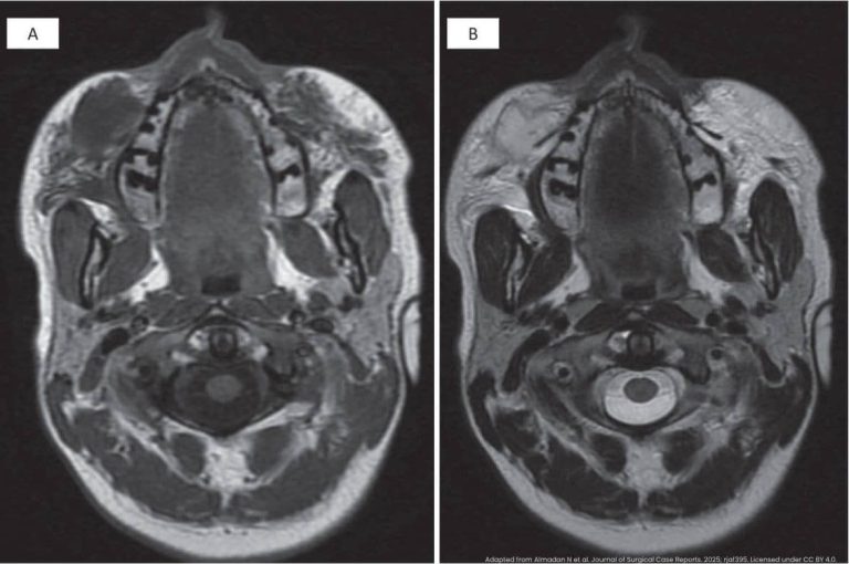 Two axial MRI scans labeled A and B showing cross-sectional views of the head and neck demonstrating granulomatous tissue reaction following hyaluronic acid filler injection, with panel B showing contrast enhancement highlighting the inflammatory mass, adapted from Almadan N et al., Journal of Surgical Case Reports, 2025, rjaf395, CC BY 4.0