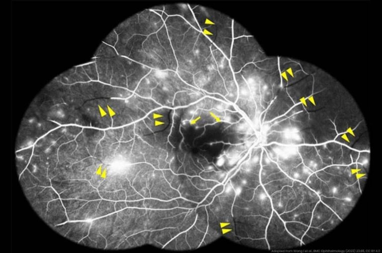 Fluorescein angiography image demonstrating multiple branch retinal artery occlusions with areas of non-perfusion following facial filler injection