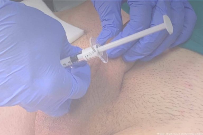 Close-up clinical image of a practitioner performing penile augmentation with a syringe injecting hyaluronic acid filler into penile tissue, demonstrating technique used in aesthetic urology procedures.