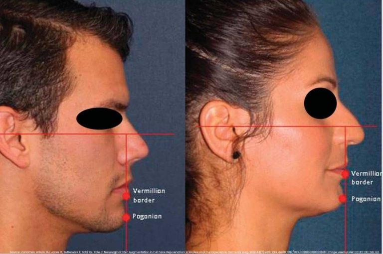 Split lateral profile photographs of a male and female patient with red alignment lines marking the vermilion border and pogonion to illustrate chin projection assessment for nonsurgical augmentation with dermal filler, adapted from Vanaman Wilson et al., Dermatologic Surgery, 2018, CC BY-NC-ND 4.0