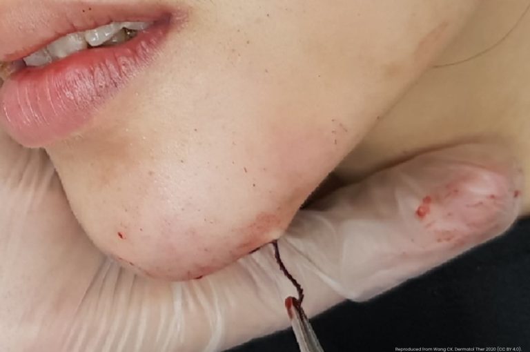 Clinical photograph showing thread extrusion complication following a thread lift procedure with a suture visibly protruding through the skin at the chin and jawline area with gloved hands managing the extruded thread, reproduced from Wang CK, Dermatologic Therapy, 2020, CC BY 4.0