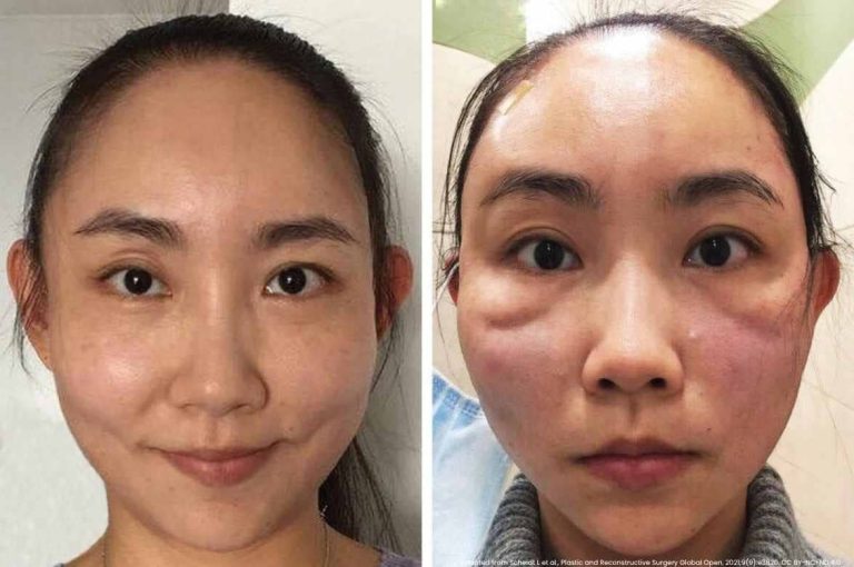 Before and after clinical photographs of a female patient showing facial swelling, erythema, and inflammatory reaction following facial thread lift procedure, from Scheidt L et al., Plastic and Reconstructive Surgery Global Open, 2021;9(9):e3820, CC BY-NC-ND 4.0