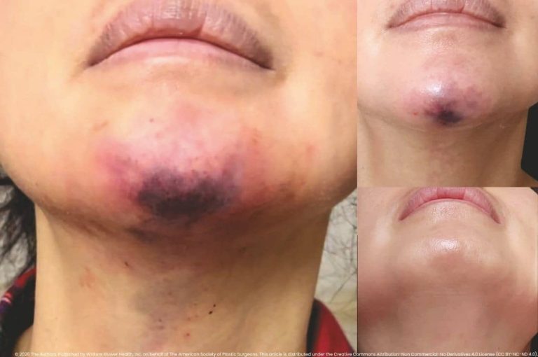 Three-panel clinical photograph showing a female patient with severe vascular occlusion following low-volume chin filler injection, presenting with extensive bruising and tissue compromise at acute stage, partial resolution at day two, and full skin recovery following high-dose pulsed hyaluronidase treatment, from the authors, published by Wolters Kluwer Health on behalf of the American Society of Plastic Surgeons, CC BY-NC-ND 4.0