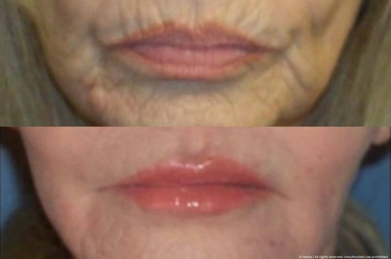 Before and after clinical photographs showing lower third, perioral region a female patient demonstrating reduction in dynamic wrinkles and improved skin texture following combination hyaluronic acid filler and neuromodulator treatment, illustrating multimodality approach to patient retention in aesthetic medicine