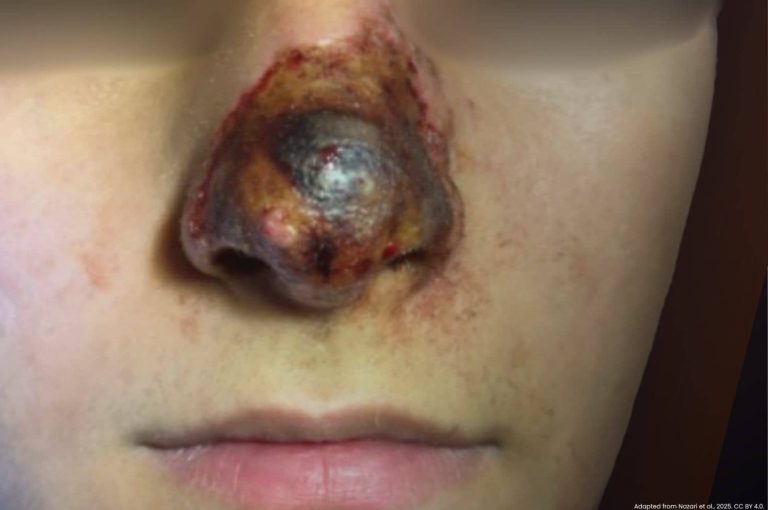 Clinical photograph showing skin necrosis and tissue damage from hyaluronic acid filler-induced vascular occlusion on the nose