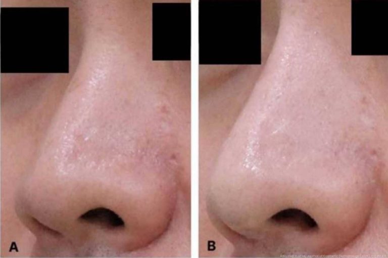 Before-and-after clinical photographs showing nasal contour refinement and reduction of alar soft tissue fullness following hyperdiluted triamcinolone injections.