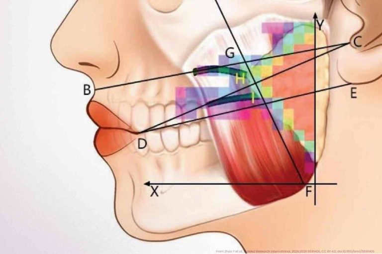 The warm zones are where you don’t want to be. This facial nerve course heatmap from Zhao et al.‘s 2026 cadaveric study on masseter anatomy makes the risk distribution visible in a way that no diagram or verbal description quite manages. The safe triangular zone △LMF — where the probability of hitting facial nerve, parotid structures, and facial vasculature is lowest — is the clinical payoff. Masseter Botox is routine until it isn’t.