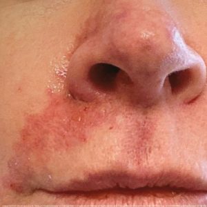 Facial vascular occlusion with tissue necrosis on cheek from dermal filler complication requiring immediate intervention