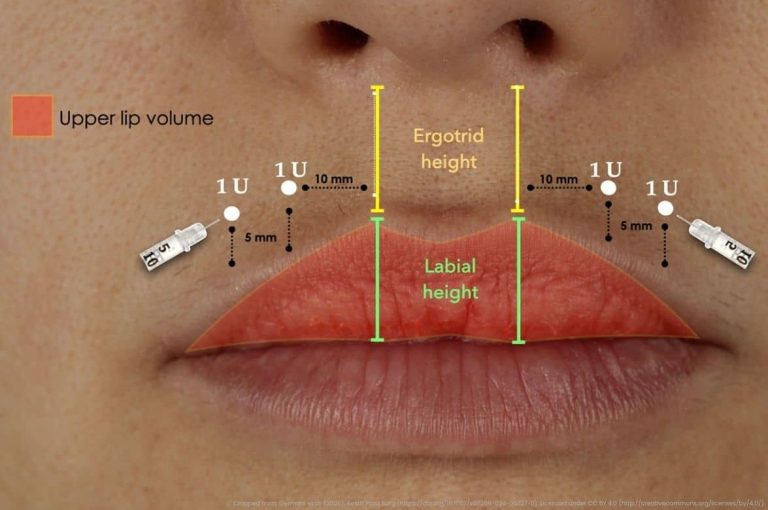 Clinical diagram mapping standardized botulinum toxin injection points and measurement areas for upper lip eversion during a lip flip procedure.