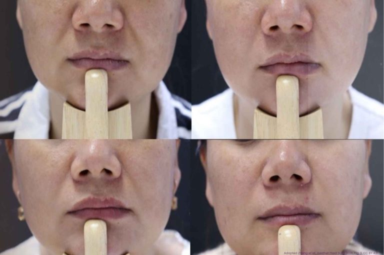 Four close-up photos of a woman's lower face showing her nasolabial folds before a porcine dermal matrix filler injection and at 6 weeks, 3 months, and 6 months after.
